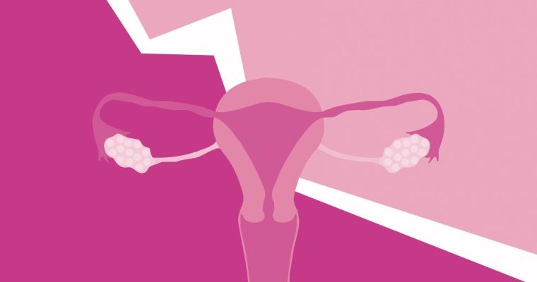 Ενδομητρίωση και Γονιμότητα - Γυναικολόγος Λάρισα - Γκορίλα Γεωργία